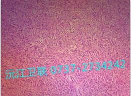 纖維肉瘤