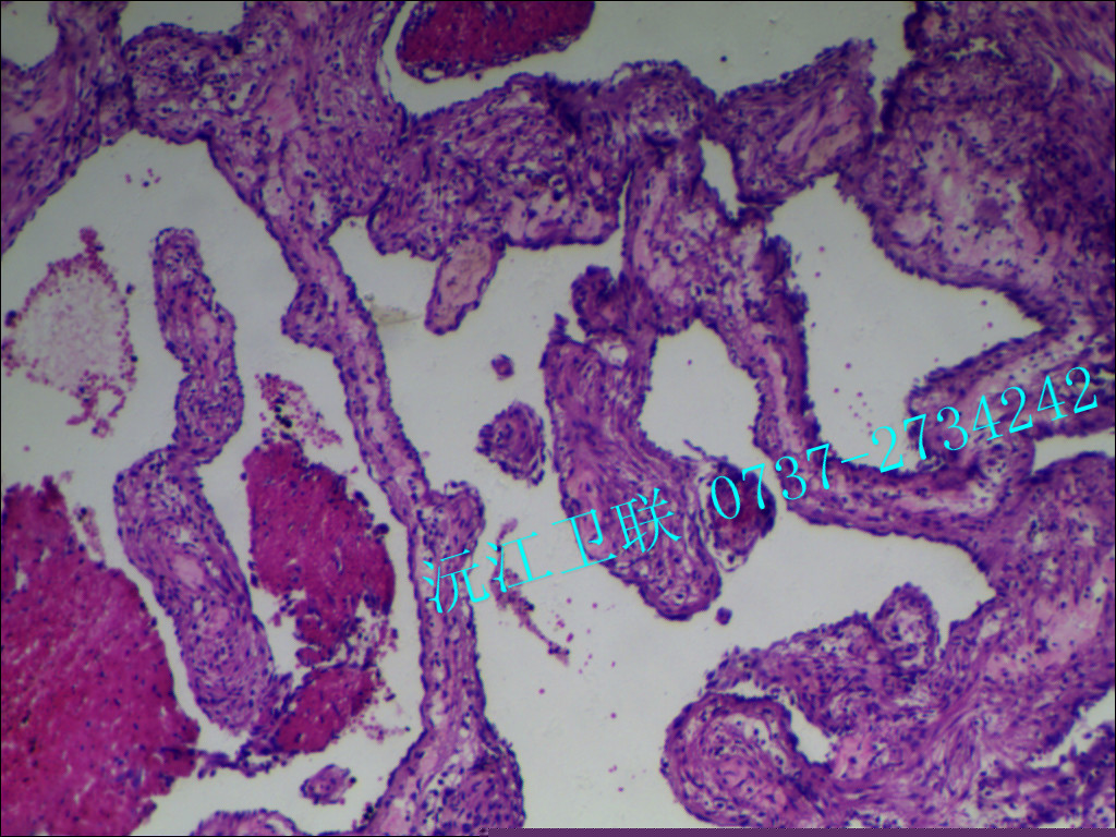 肝海綿狀血管瘤